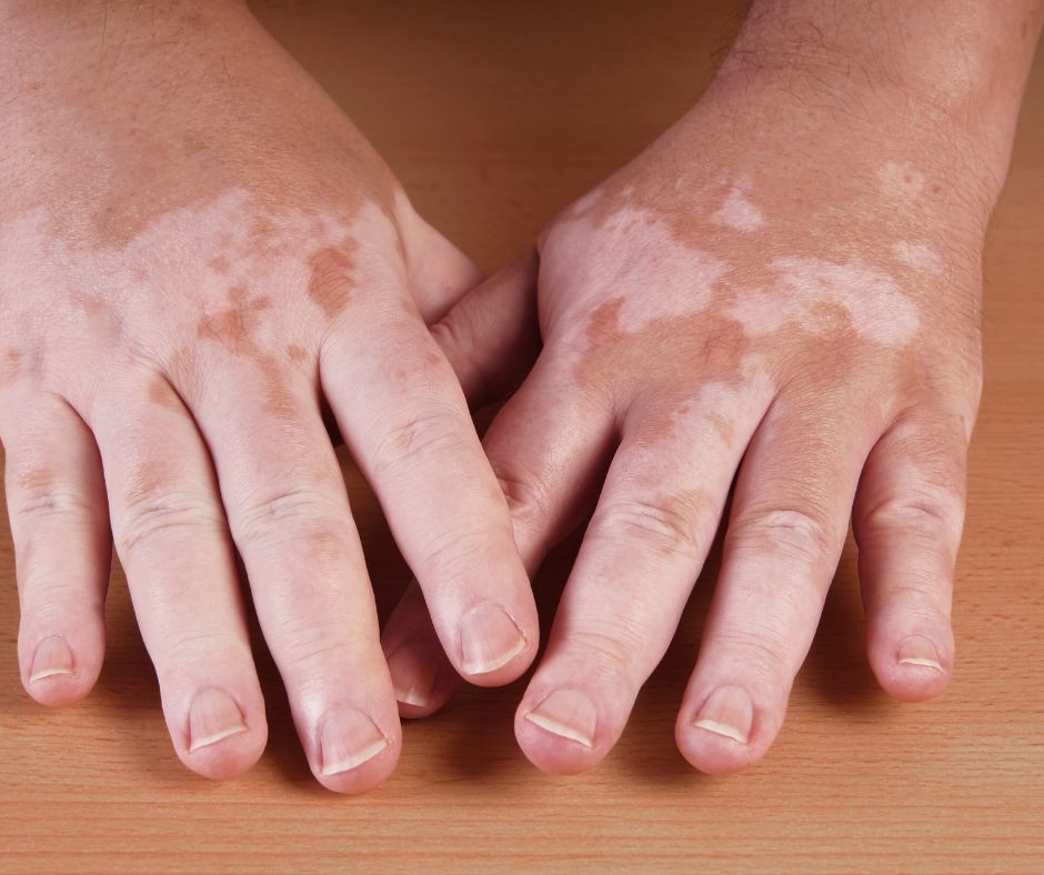 Vitiligine, visite gratuite al Policlinico universitario