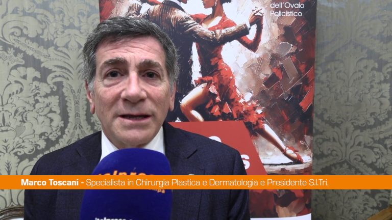 PCOS, Toscani “Acne e alopecia segni clinici principali”