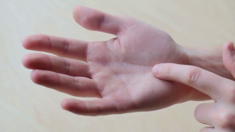 Sindrome del tunnel carpale, ecco chi è più a rischio