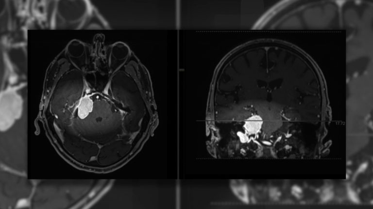 Meningiomi, i sintomi da tenere d’occhio