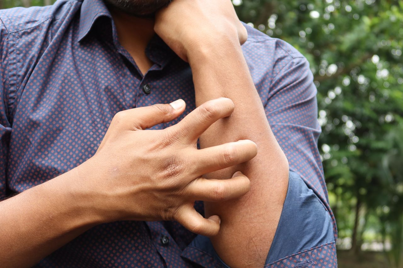 Studio Novartis, l’orticaria cronica spontanea costa 4.200 euro l’anno a paziente